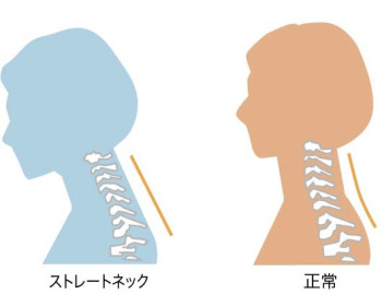 ストレートネックの治し方