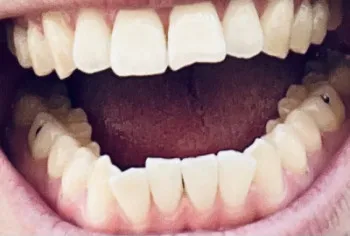 【4ヶ月おき】歯のクリーニング