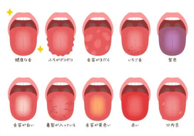 舌診（ぜっしん）?