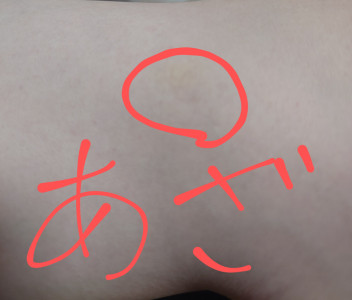 知らぬ間にアザが