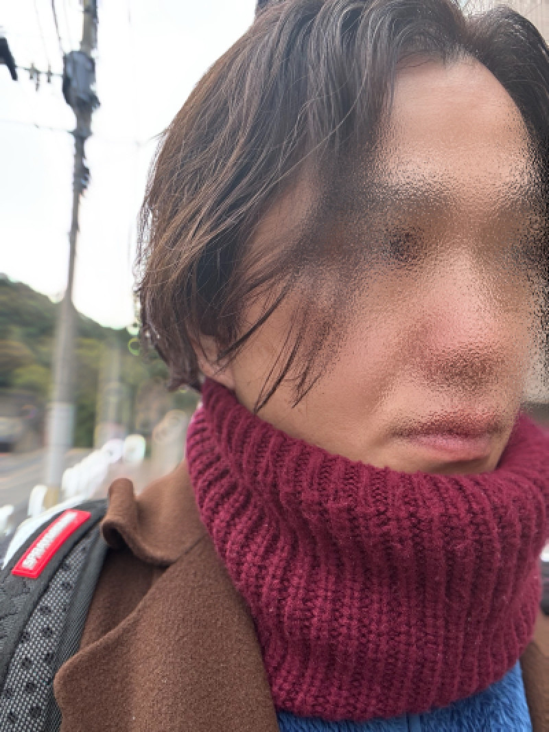 捻挫しちゃいました